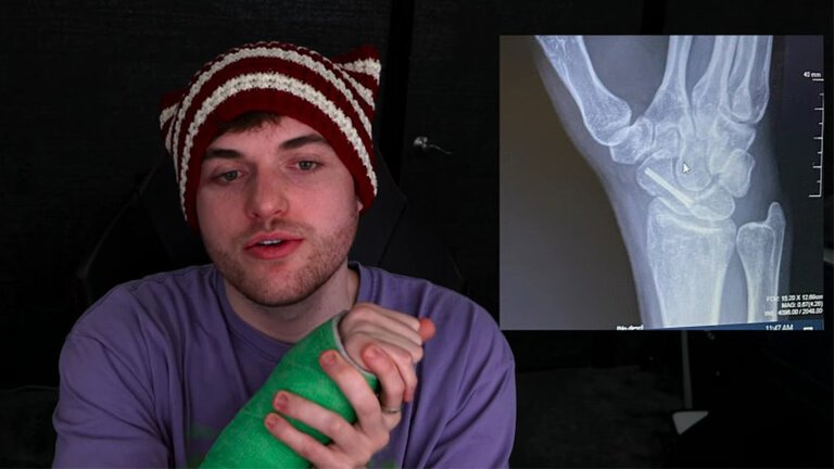 Dream “scared” for Minecraft career after breaking wrist in sparring bout