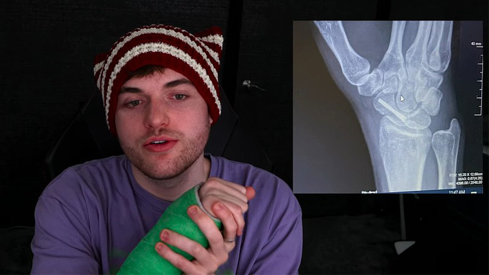 Dream “scared” for Minecraft career after breaking wrist in sparring bout